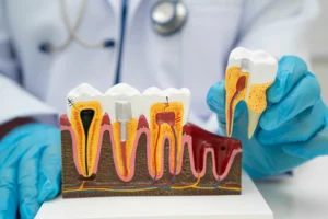 Root Canal Treatment in Long Beach: Save Your Tooth with Salem Dentistry